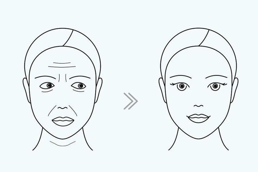 Salmon DNA skin boosters, injectable fillers: non-invasive plastic surgery boosts medical tourism in South Korea