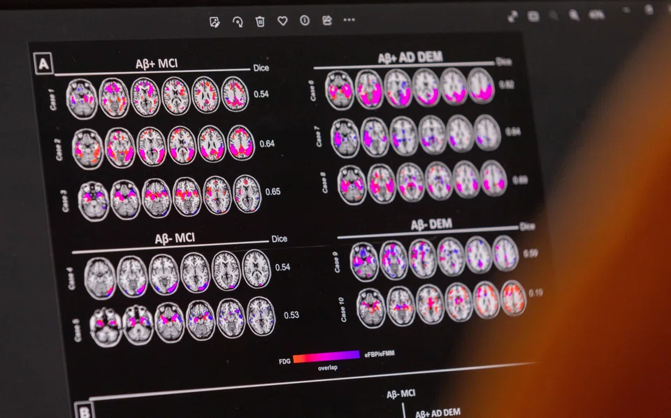 Neuroimages of a patient suffering from Alzheimer's disease. The first drug to treat Alzheimer's disease received FDA approval this year.