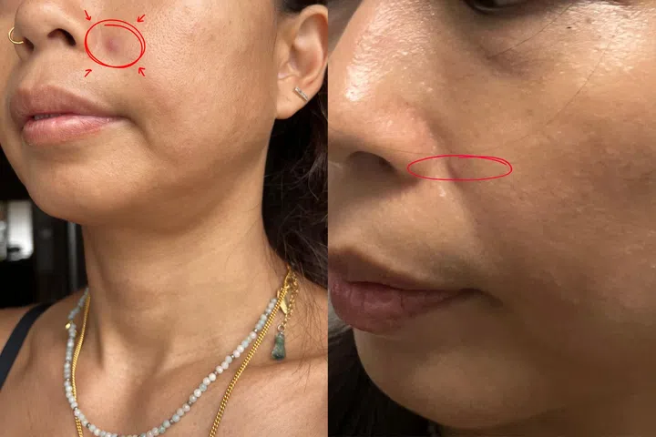 The Ordinary’s new Instant Powder-To-Creme Acne Treatment