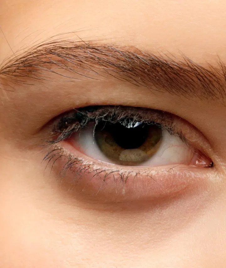 dark eye circles