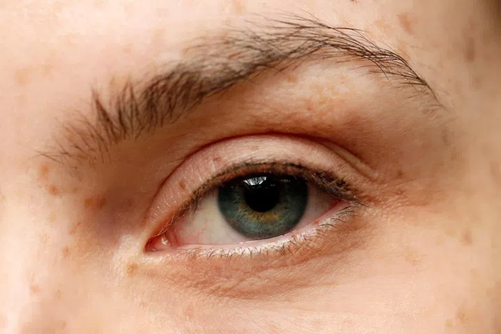 dark eye circles