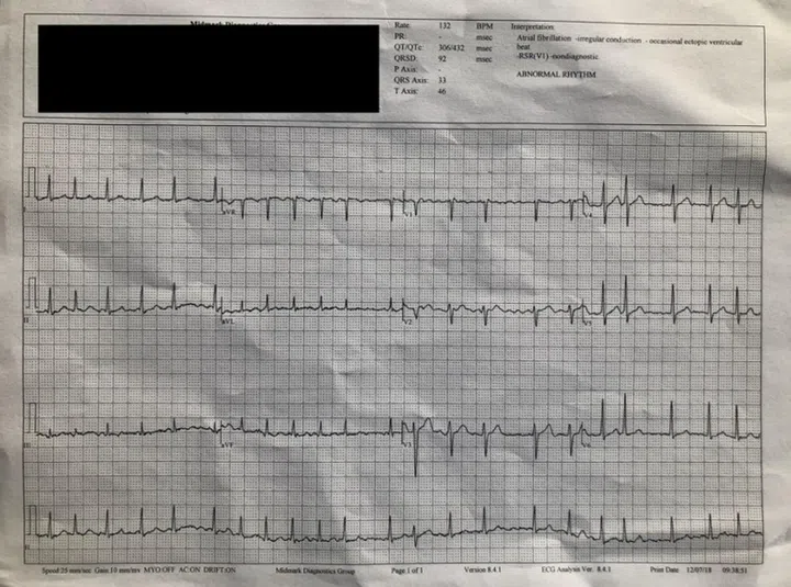 A section of the ECG that was run by the doctor at the clinic. <br>Image source: edentel