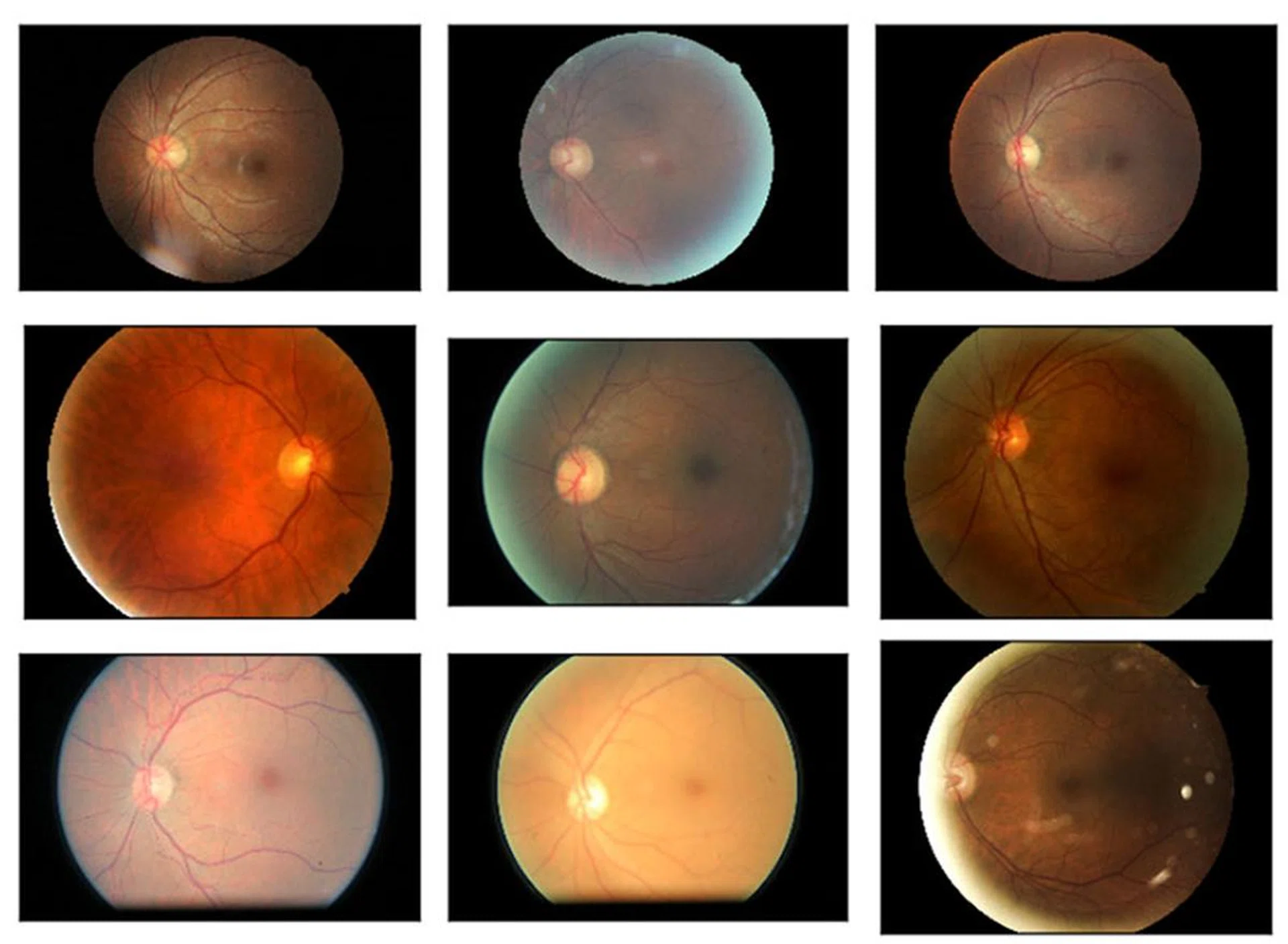 Diabetic retinopathy is exceedingly time consuming to diagnose, which is why more efficient and automated methods are needed. (Image Source: Kaggle)