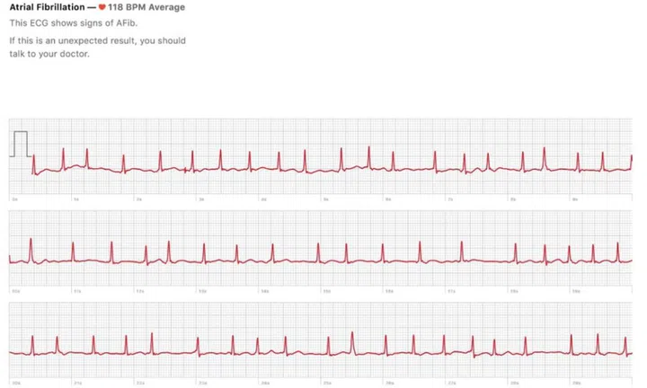 An export of the ECG results from the Apple Health app. <br>Image source: edentel