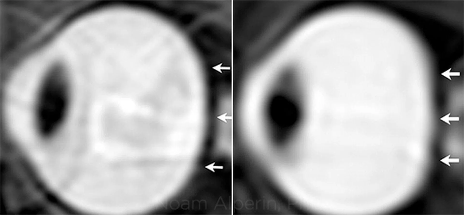 Before space travel (left) and after. (Image Source: American Academy of Ophthalmology)