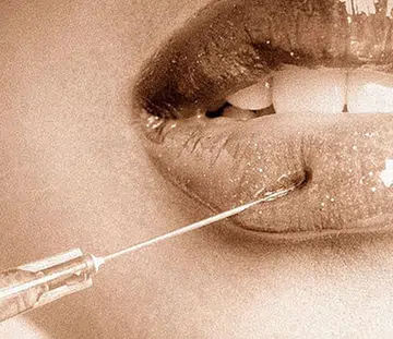 lip fillers