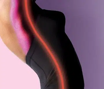 Stretch Marks