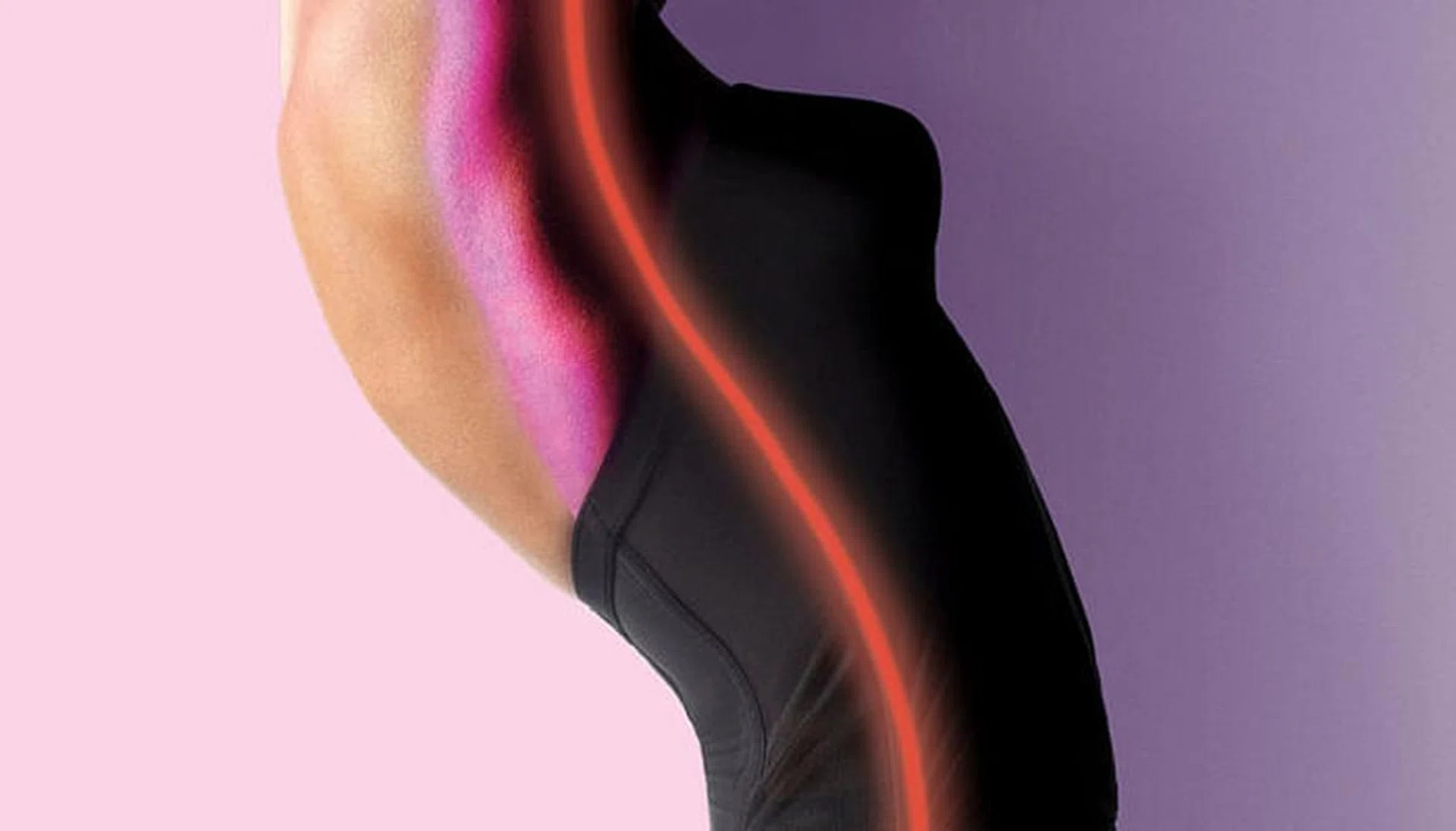 stretch marks