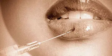 lip fillers