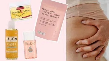 Stretch marks