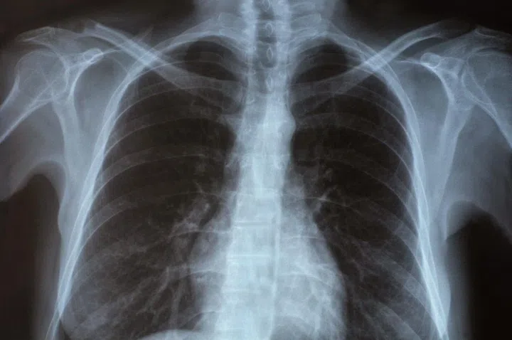 X-ray of the lungs