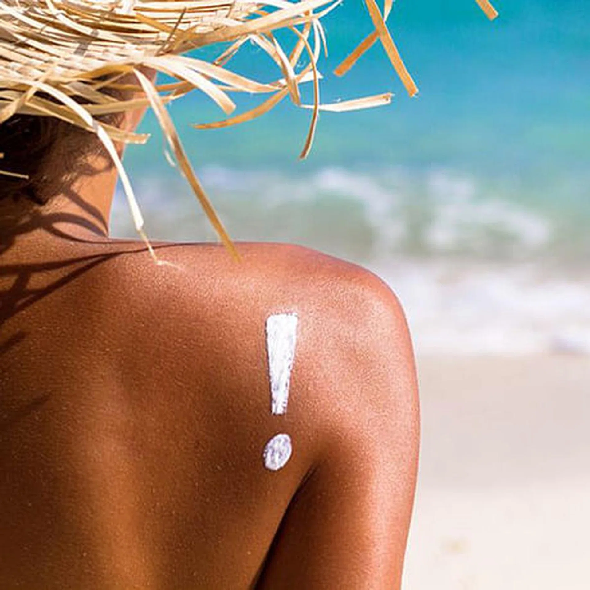 How to treat sunburn