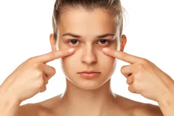 Dark Eye Circles