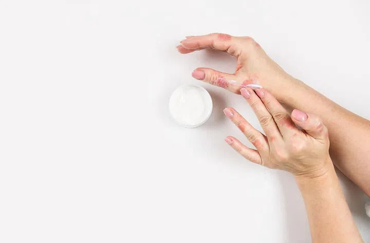 A woman applies cream to her hands to treat dermatitis. Skin diseases. Close-up. Flat lay.