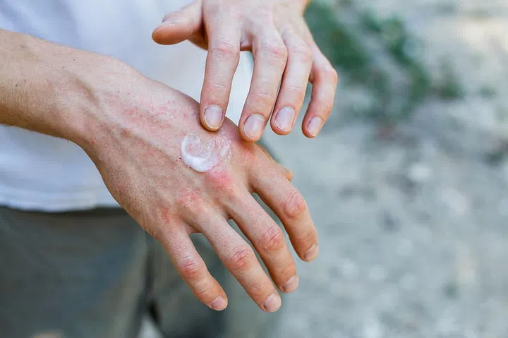 Ointment on hand. Applying the ointment in the treatment and hydration of the skin.