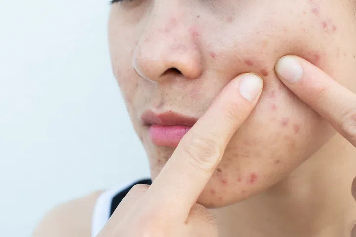 Conceptual of problems with acne and scar on the female skin.