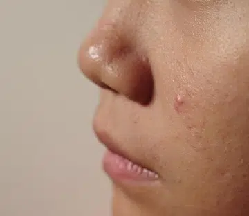 Acne-prone skin
