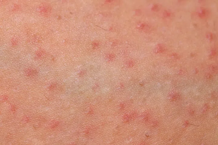Close up picture of folliculitis problem on female skin