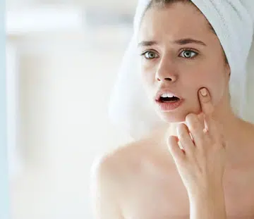 acne_treatments_singapore