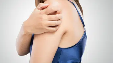 That persistent itch may not be a simple heat rash. Chronic spontaneous urticaria causes intense, recurring hives with no clear trigger. 