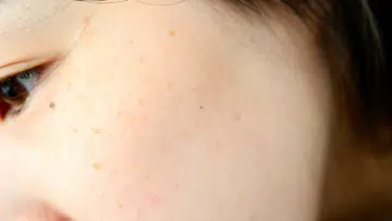 dark spots and melasma