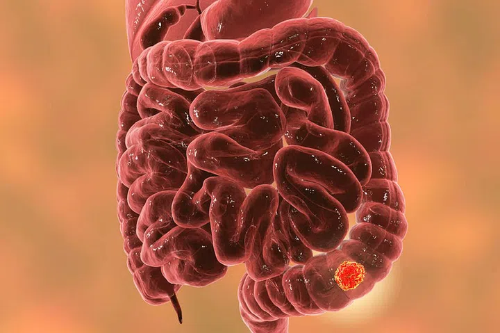 Colorectal cancer awareness medical concept, 3D illustration showing cancerous tumor inside large intestine