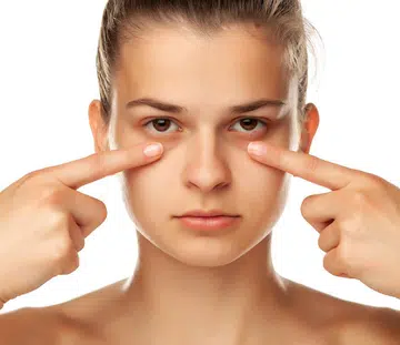Dark Eye Circles