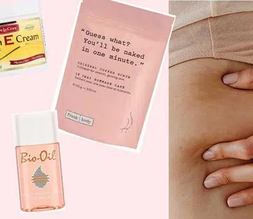 Stretch marks