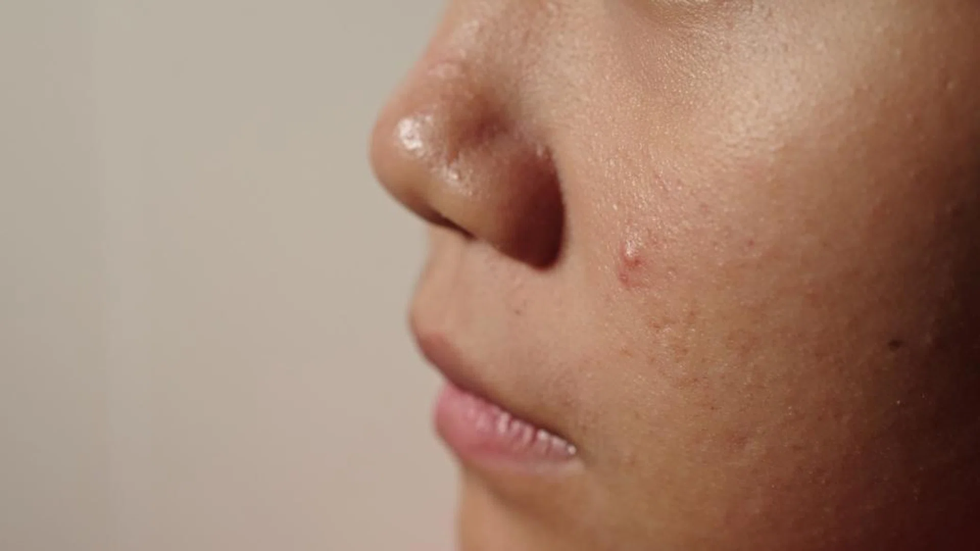Acne-prone skin