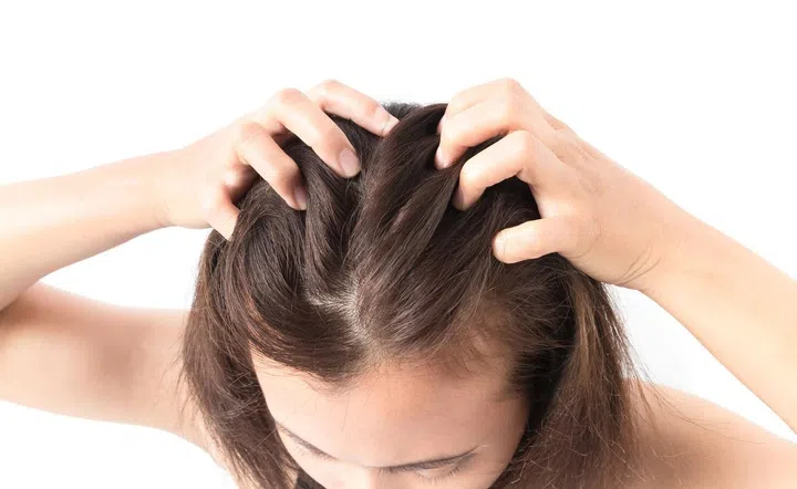 71537849 - closeup woman hand itchy scalp, hair care concept