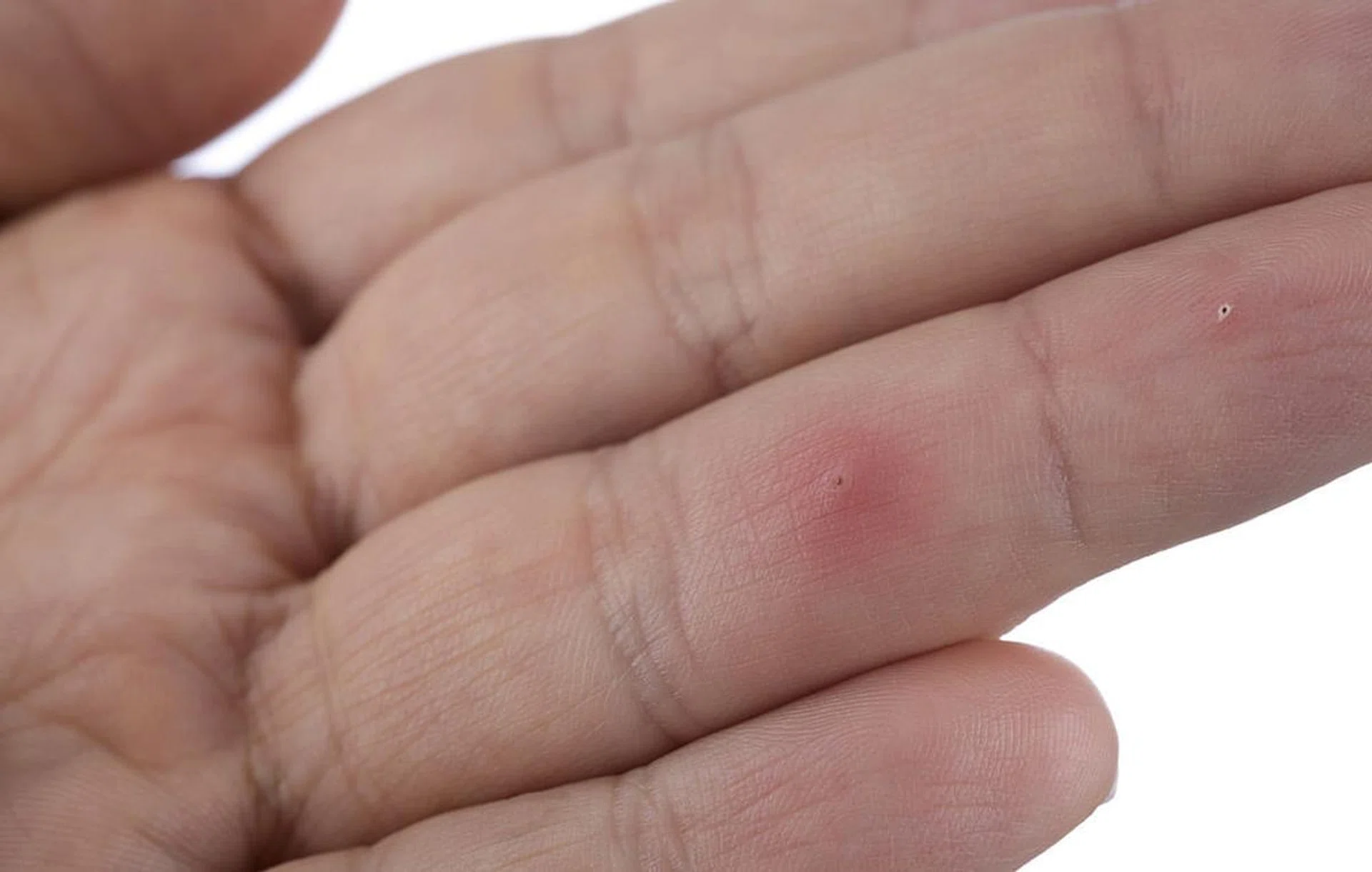 Close up of splinter stuck under skin. Image from Shutterstock