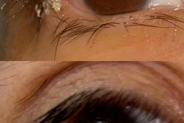 Aden’s right eye suffered from formaldehyde-induced conjunctivitis that resulted in wound infection. The lid had to be stitched shut to hasten the healing process.