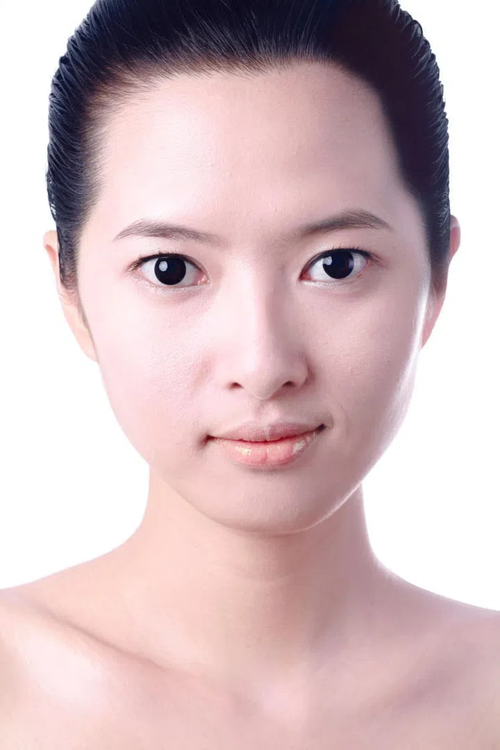 Melasma
