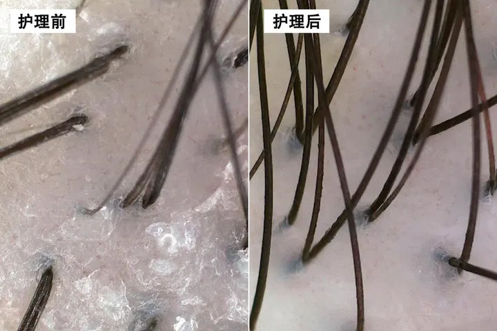 通过Tricho-Scan客户能了解护理前后头皮的变化，评估护理效果。