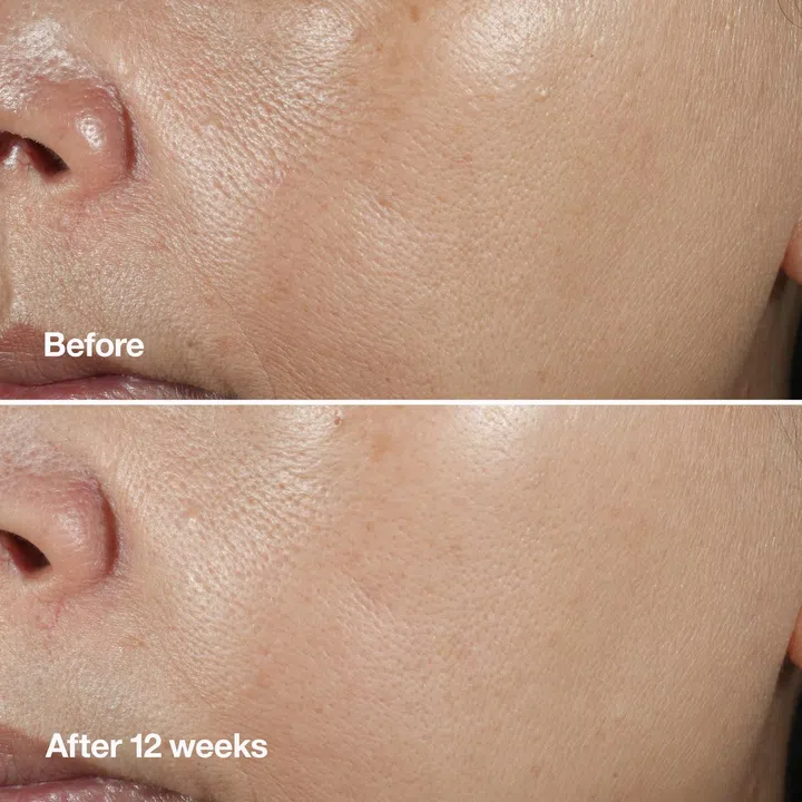 在使用Clinique Smart Clinical Repair Wrinkle Correcting Serum精华12周后，细纹与皱纹明显减少出现。