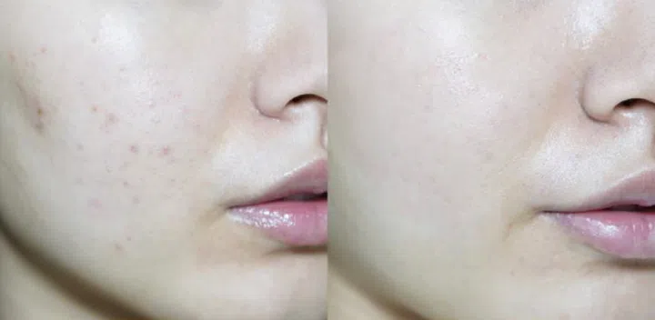使用Even Better Clinical Radical Dark Spot Corrector + Interrupter美白精华7天的前后对比**。