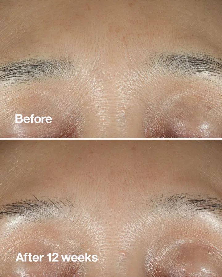 在使用Clinique Smart Clinical Repair Wrinkle Correcting Serum精华12周后，肌肤看起来更加光滑，细纹也减少出现。