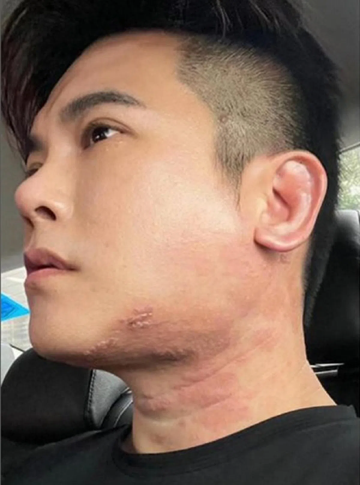 沈炜竣起初以为颈项和脸上的红疹只是一般的皮肤过敏。（Instagram/nickshenweijun）