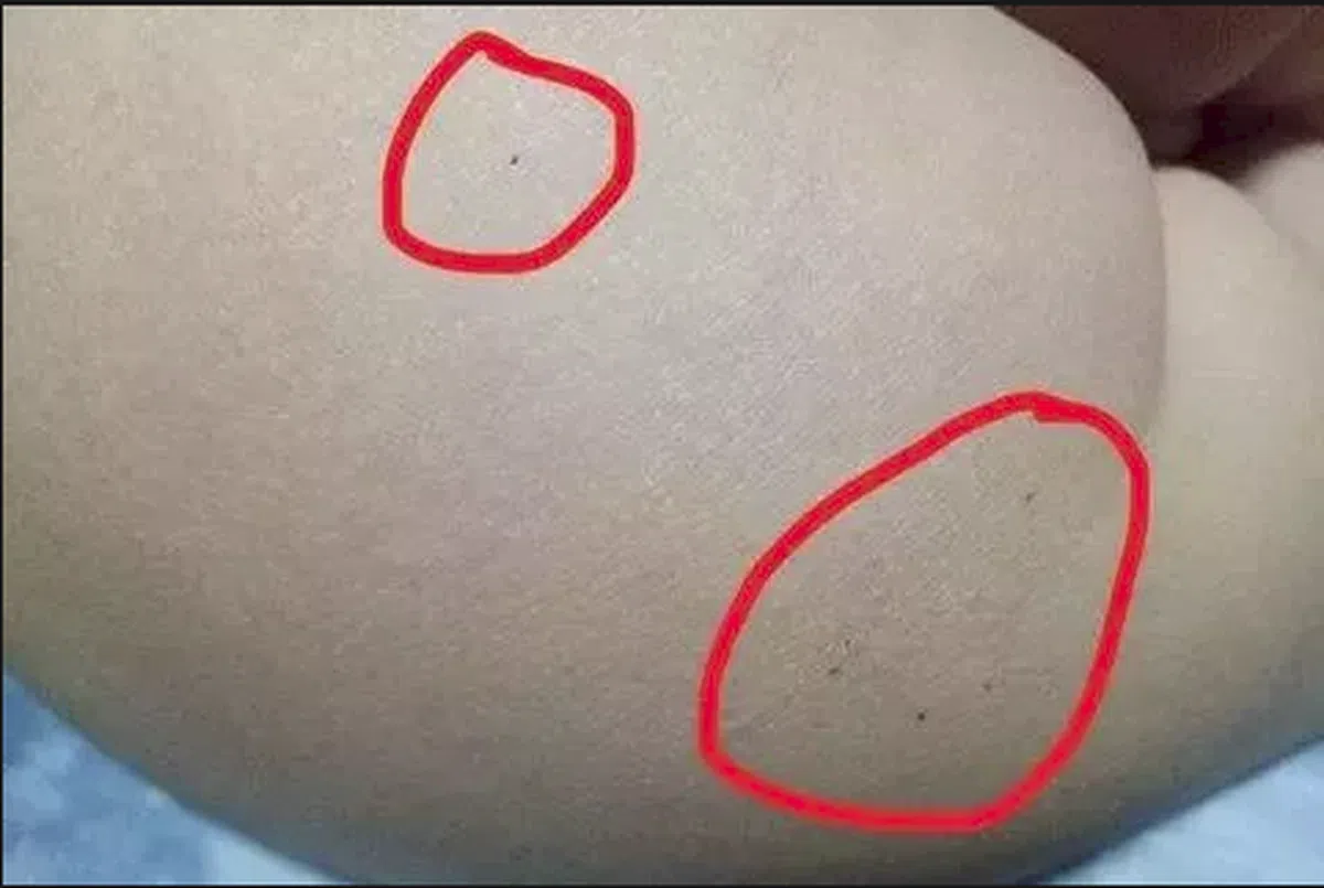  据多名红黄蓝（新天地分园）家长反映，孩子腿部、屁股、腋下出现针眼。图片源于学生家长 