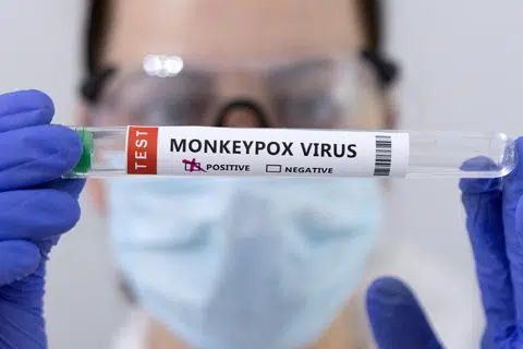 世卫宣布为“猴痘”改名，并开放让公众参与提出建议。（路透社）