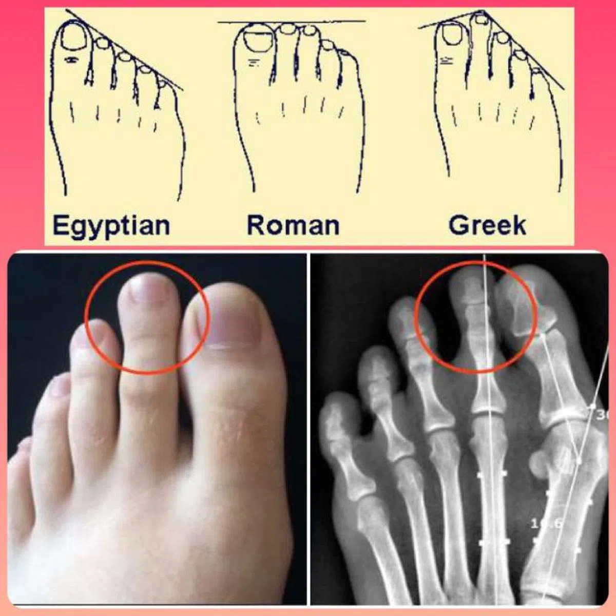 埃及脚、罗马脚以及希腊脚。（乐霖物理治疗所脸书）