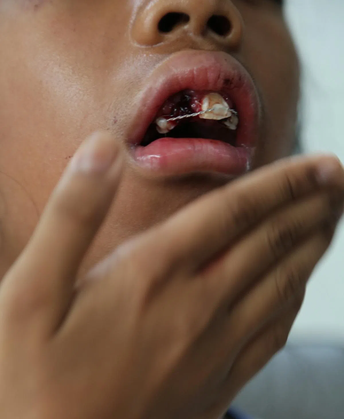  被踏板车撞伤的女生两颗牙齿被撞断，下颚被撞歪，脸颊擦伤，差点就撞伤了眼睛。（联合晚报） 