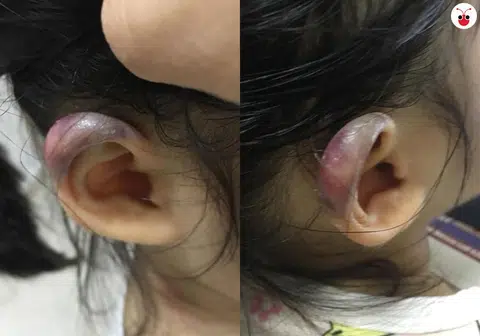 三岁女童托儿所放学回家，父亲途中发现女儿耳轮严重淤青及肿胀。（Claudia Kwan面簿）