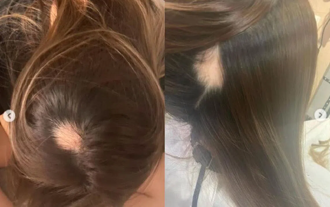 网红陈淑芬在Instagram上载自己脱发的照片，分享经历。（取自Instagram／红蚂蚁制图）