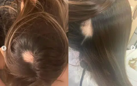 网红陈淑芬在Instagram上载自己脱发的照片，分享经历。（取自Instagram／红蚂蚁制图）