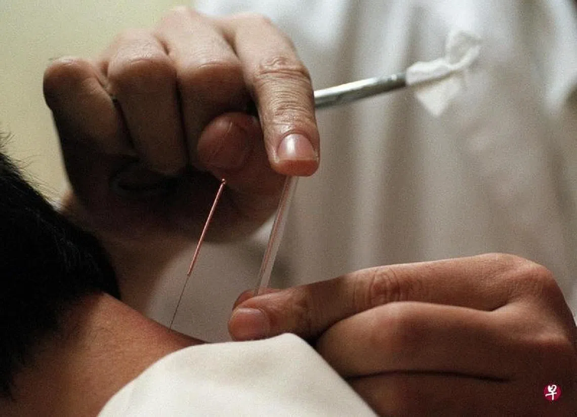 针灸治疗。（联合早报）