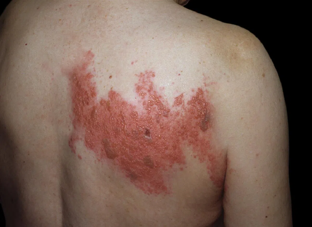 小时候出过水痘，长大后就有可能感染带状疱疹。（全国皮肤中心）