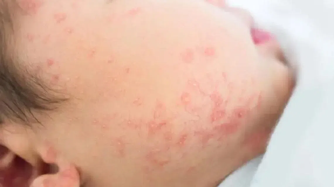 （示意图）本地11起病例中，包括三名未满12个月、尚未符合麻疹、腮腺炎和风疹（MMR）疫苗接种条件的婴儿。