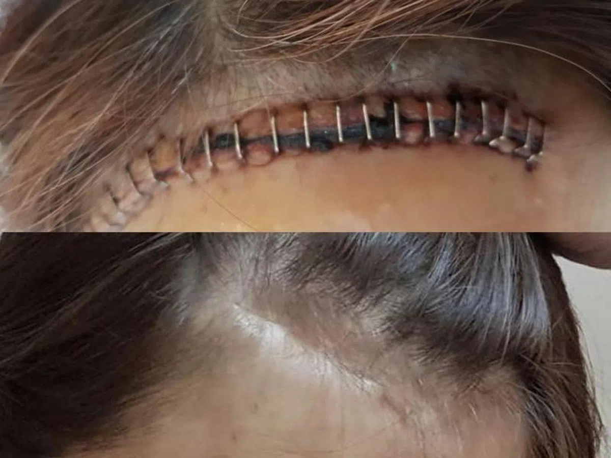  （上图）妇女被电动踏板车惊吓而跌倒后摔破头，须开头壳清淤血，头颅打上30钉。（下图）时隔一年半仍然留下凹痕。（联合早报） 