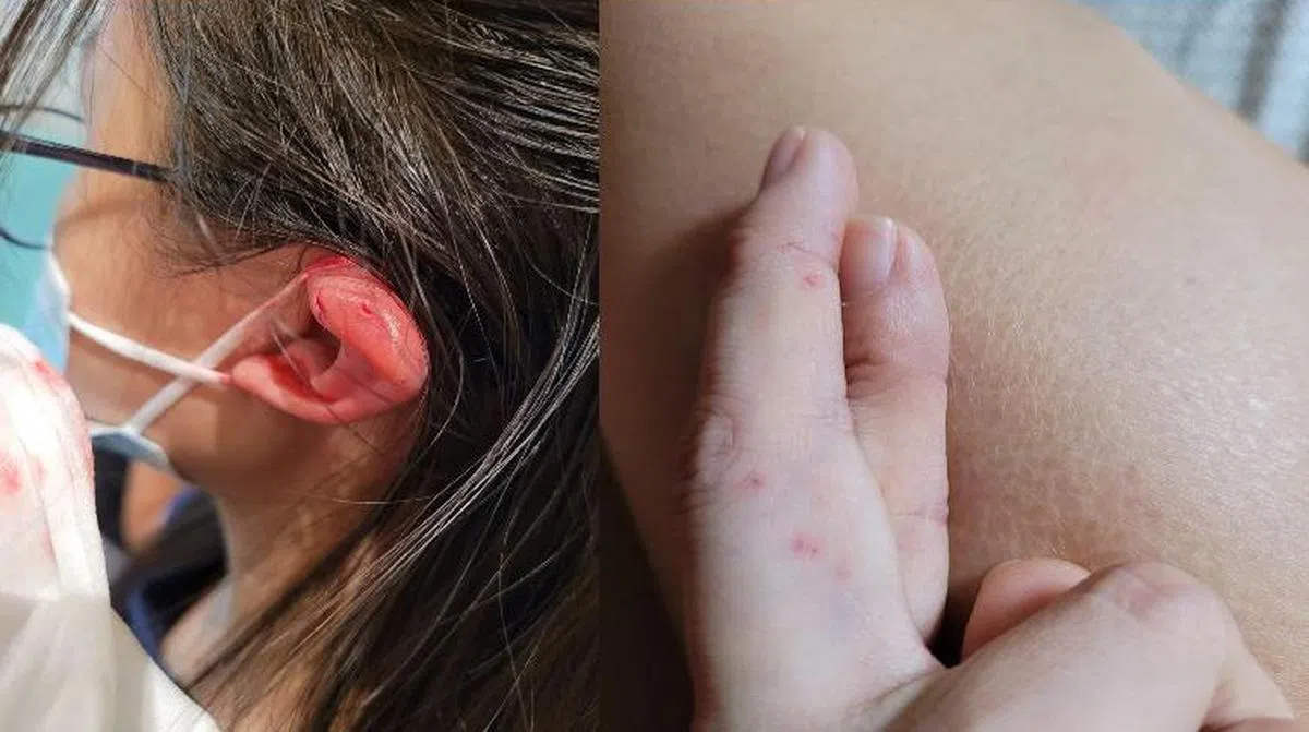 女儿的左耳（左）被鹦鹉啄到鲜血直流，母亲的手指（右）也被啄了五下。（陈玲丽脸书）